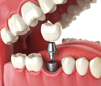 Dentists at Nashua Cosmetic and Restorative Dentistry explain How implants can replace a single tooth for Nashua area patients