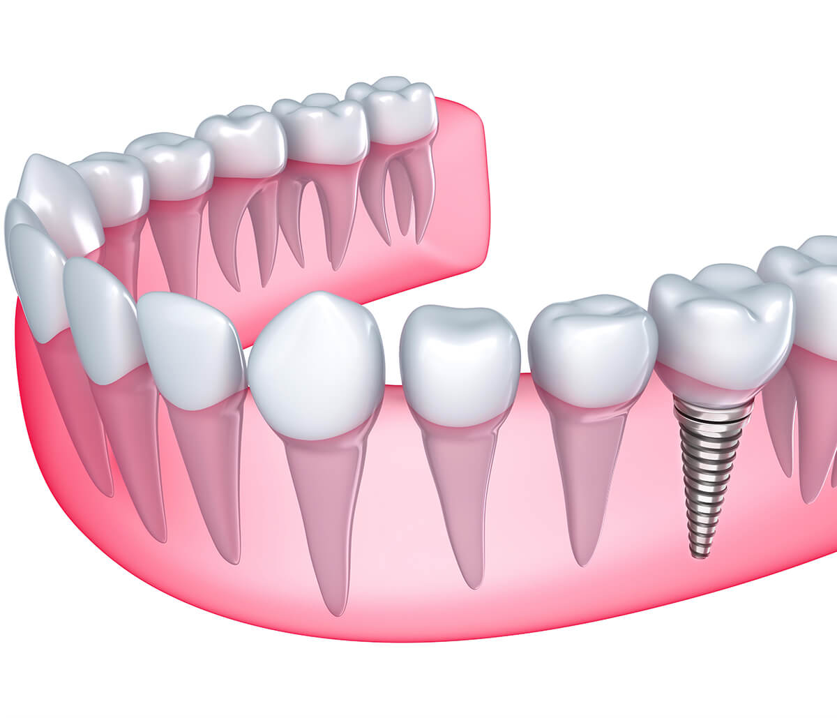 Dental Implants 101: All You Need to Know About Dental Implants Treatment in New Hampshire