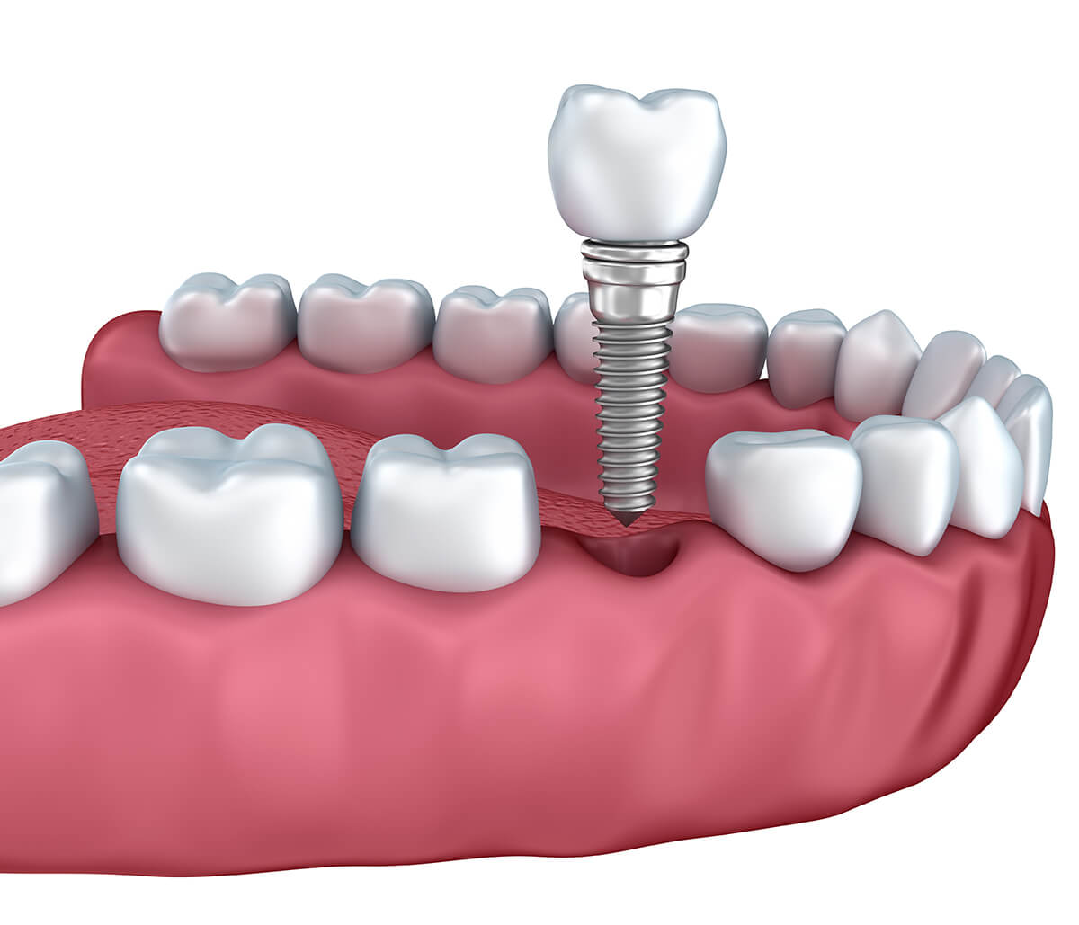 New Teeth Implants in Nashua NH Area
