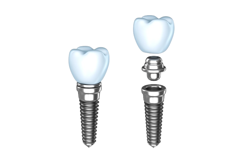 What to expect from the “gold standard” in tooth replacement with dental implants